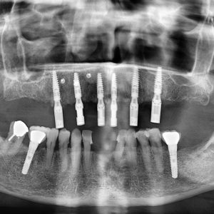 Masterclass : réhabilitation d'une arcade complète en chirurgie pilotée - Dr Monin
