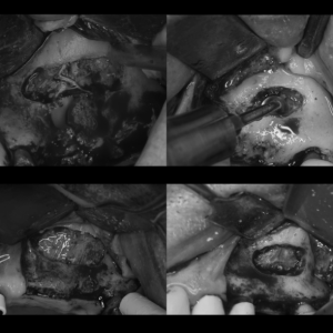 Sinus lift et alternatives