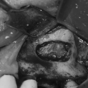 Sinus lift et alternatives